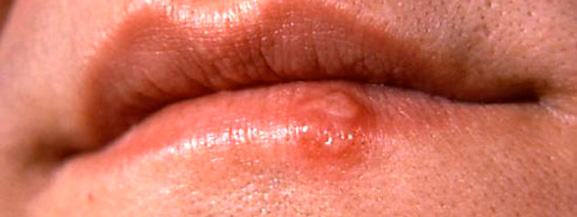 причины пояления простуды на губах