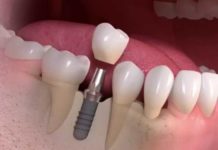 Виды имплантации зубов