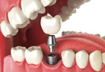 Что такое протезирование зубов?