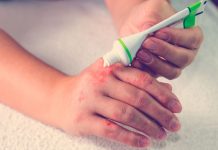 Лечение экземы современными способами