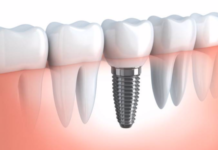 Имплантация зубов All-on-6