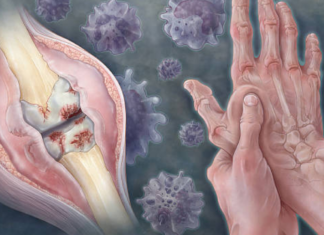 Группа риска по подагрическому артриту
