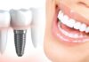 Имплантация зубов: особенности