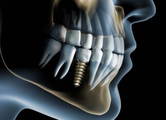 Имплантация зубов: насколько сложная процедура
