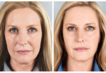 Игольчатый лифтинг: в чём польза