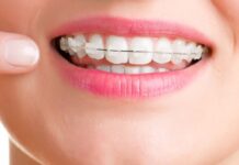 Металлические самолигирующие брекеты: достоинства