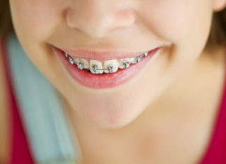 Как проходит исправление прикуса?