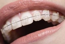 Брекеты: для чего они нужны