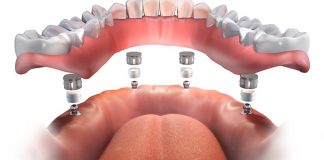Технология зубной имплантации All-on-4: преимущества