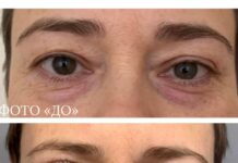 Как убрать нависшее веко