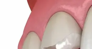 Что такое реставрация зубов?