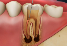 Осложненный кариес — разновидности и лечение