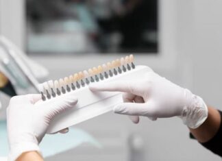 Преимущества виниров: почему они популярны?