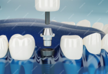 Имплантация зубов: технология полного восстановления функций