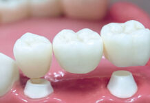 Зубной мост: что это, кому подходит и в чем его плюсы