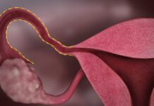 Что такое тубэктомия и как она влияет на здоровье?