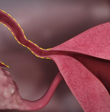 Что такое тубэктомия и как она влияет на здоровье?